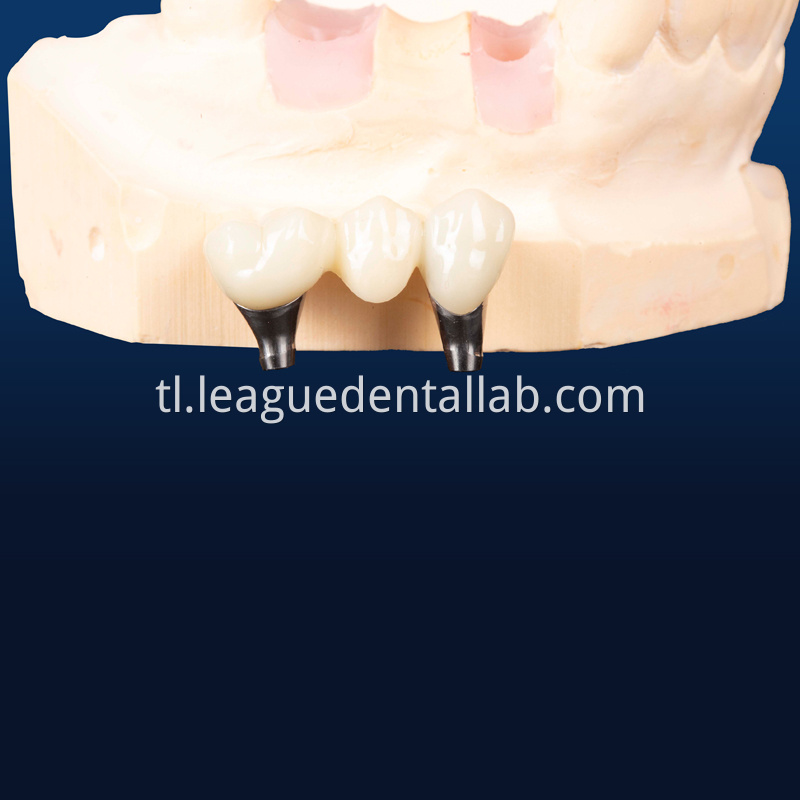 Dental Implant Crown, Dental Implant Zirconia crown,Dental Implant Emax crown,Dental Implant Bridge